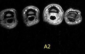 Figure 5 for case A2 pulley rupture finger (RID2437)